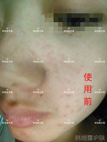 額頭長痘臉頰長痘痘粉刺，這樣調(diào)理幫你恢復(fù)嫩白肌膚！