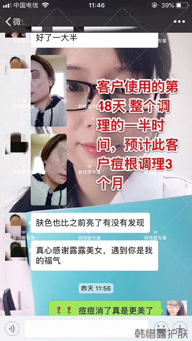 臉上一直長痘痘膿包怎么解決？痘痘開始消了，更美麗！