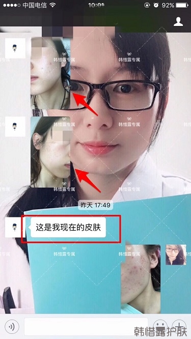 痘痘好了皮膚美麗，不想再記起曾經(jīng)滿臉痘痘的自己！