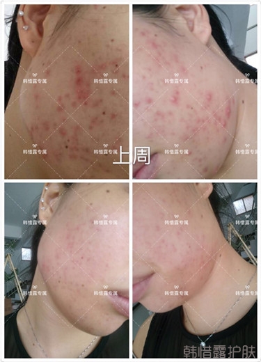 痘痘好多了，認(rèn)真聽話按照要求使用，每個(gè)人都可以變很美！