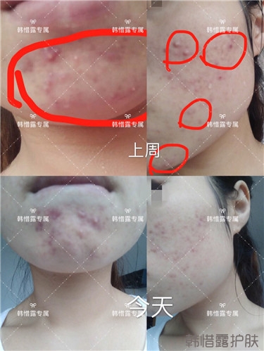 粉刺只剩一點(diǎn)點(diǎn)了，敏感肌粉刺修復(fù)，更美麗！