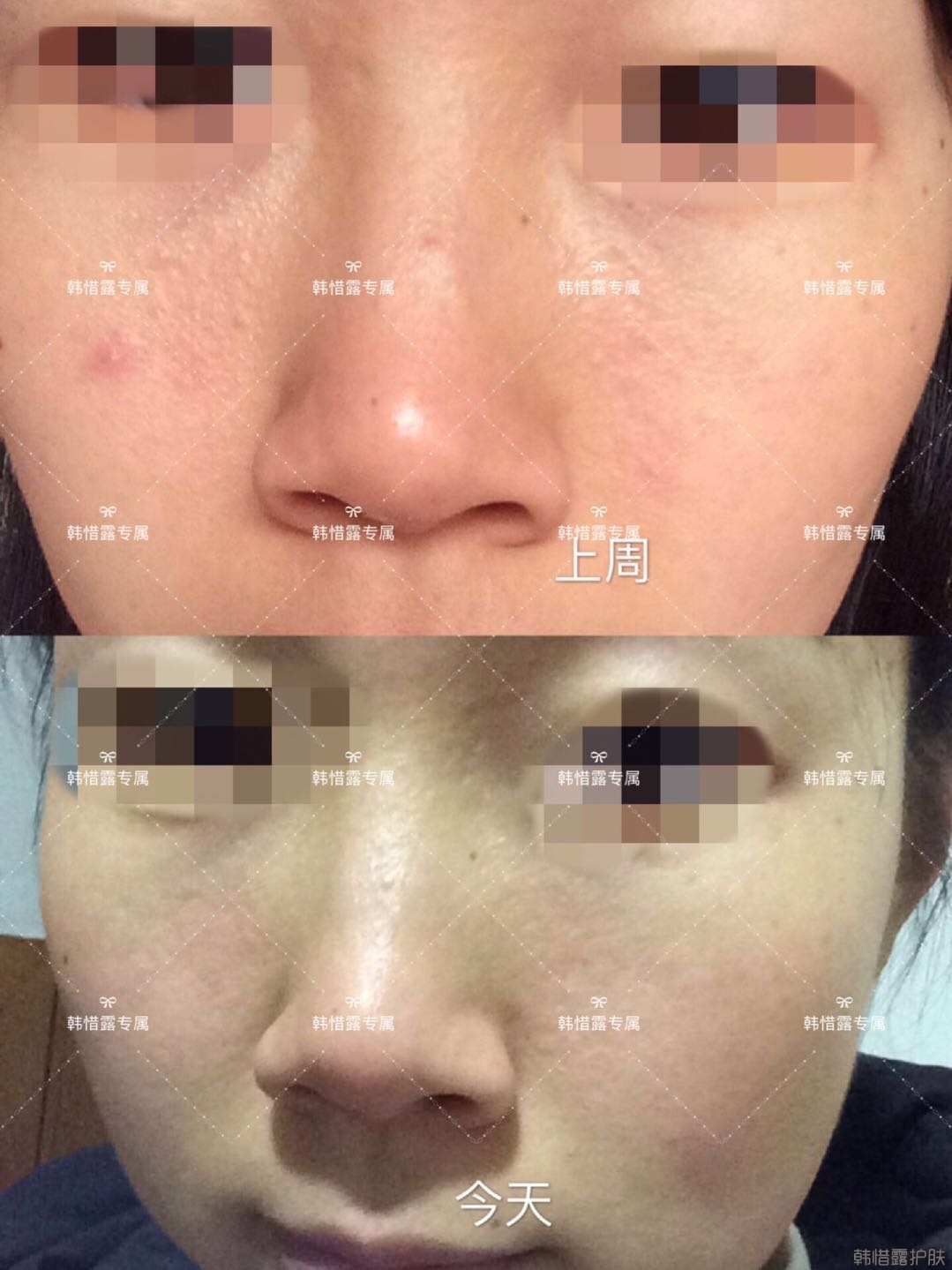 粉刺痘痘怎么有效去除？以前不敢拍燈光下照片，粉刺少了，現(xiàn)在敢了！