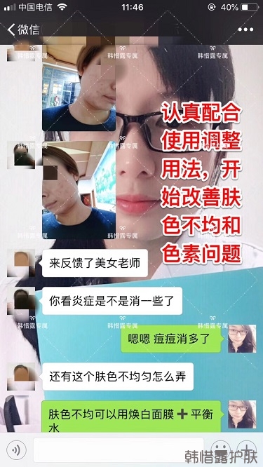 臉上一直長痘痘膿包怎么解決？痘痘開始消了，更美麗！