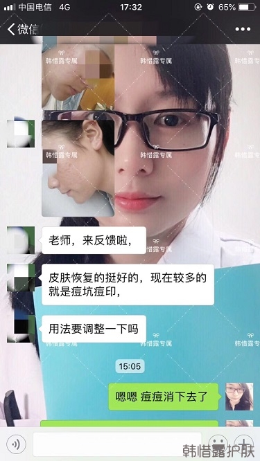 好好使用，膿包痘痘,小粉刺全消了,重點修復痘印痘坑印了