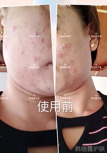 臉上一直長痘痘膿包怎么解決？痘痘開始消了，更美麗！