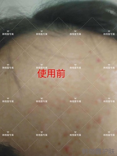 額頭長痘臉頰長痘痘粉刺，這樣調(diào)理幫你恢復(fù)嫩白肌膚！