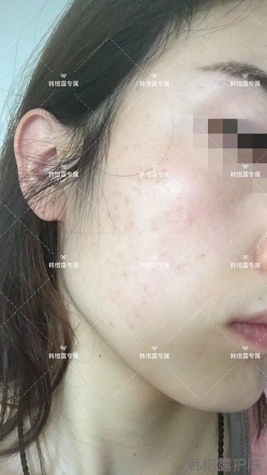痘痘好了皮膚美麗，不想再記起曾經(jīng)滿臉痘痘的自己！