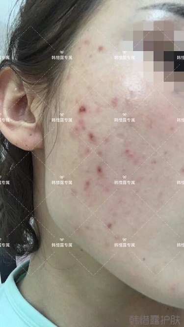 痘痘好了皮膚美麗，不想再記起曾經(jīng)滿臉痘痘的自己！