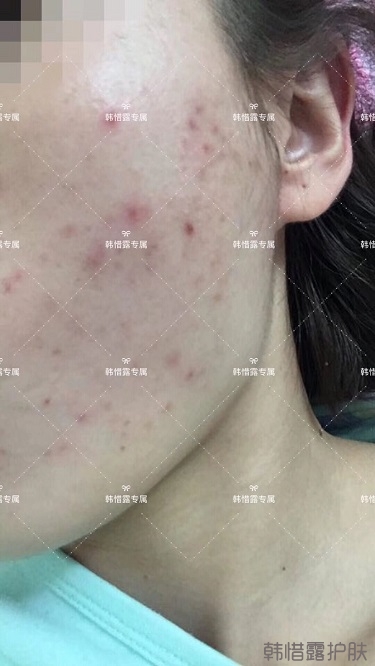 痘痘好了皮膚美麗，不想再記起曾經(jīng)滿臉痘痘的自己！