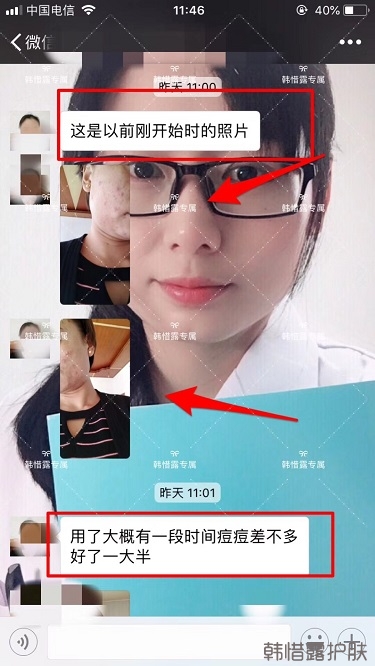 臉上一直長痘痘膿包怎么解決？痘痘開始消了，更美麗！