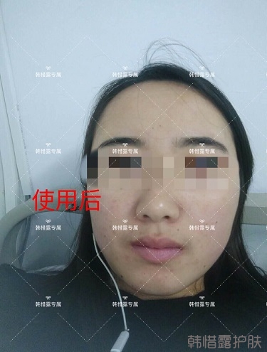 額頭長痘臉頰長痘痘粉刺，這樣調(diào)理幫你恢復(fù)嫩白肌膚！