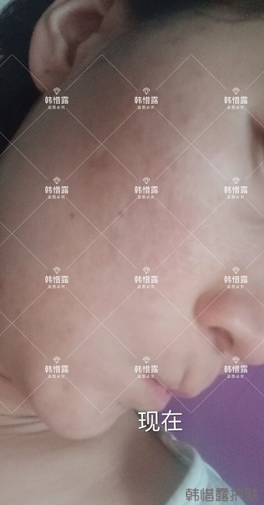 化妝品店主的變臉級祛痘反饋，粉刺痘痘全部消了