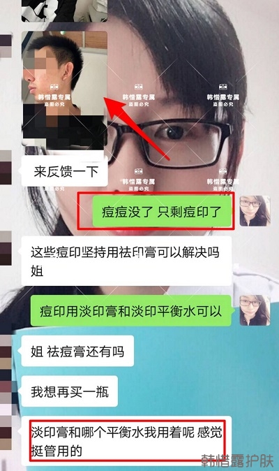 痘印怎么去？痘印調(diào)理案例，痘印淡化了