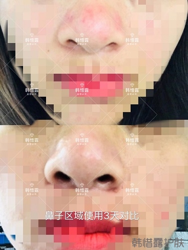 鼻子發紅長痘痘消了，皮膚吸收好就是任性！
