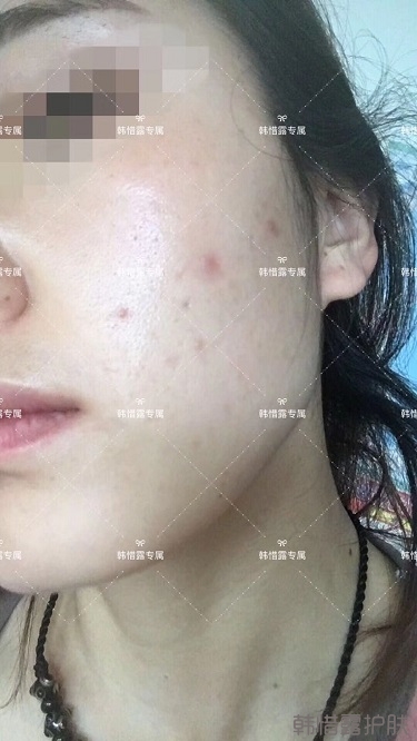 痘痘好了皮膚美麗，不想再記起曾經(jīng)滿臉痘痘的自己！