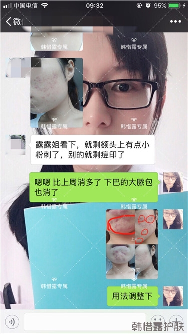 粉刺只剩一點(diǎn)點(diǎn)了，敏感肌粉刺修復(fù)，更美麗！