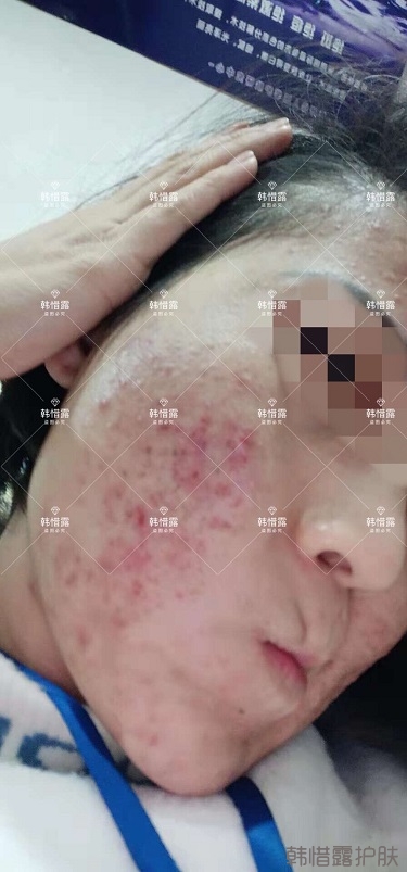 化妝品店主的變臉級祛痘反饋，粉刺痘痘全部消了