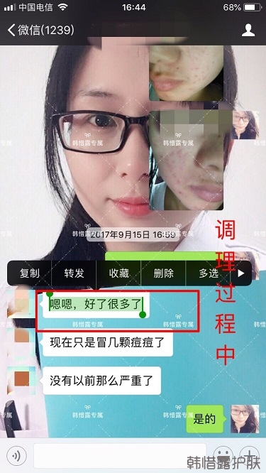 額頭長痘臉頰長痘痘粉刺，這樣調(diào)理幫你恢復(fù)嫩白肌膚！