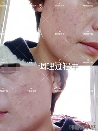 臉上一直長痘痘膿包怎么解決？痘痘開始消了，更美麗！