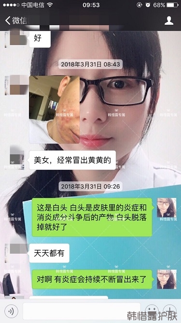 膿包結節發硬痘痘全消了，帥哥開心的來反饋了！