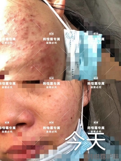 臉上長閉口粉刺怎么去除,粉刺消下去了，皮膚變好了
