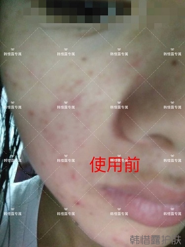 額頭長痘臉頰長痘痘粉刺，這樣調(diào)理幫你恢復(fù)嫩白肌膚！