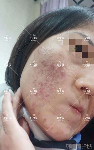 化妝品店主的變臉級祛痘反饋，粉刺痘痘全部消了
