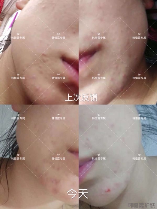 粉刺多怎么辦？按照要求配套耐心使用，粉刺消下去不少！