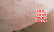 臉上長粉刺去粉刺的方法!不可錯過的去痘痘粉刺變美機會！