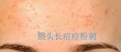 額頭長痘，臉頰長痘痘粉刺，就這樣恢復嫩白肌膚！