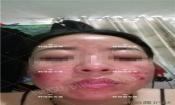 【祛痘視頻反饋】激素臉長痘20多年，大膿包，發癢，完全恢復！