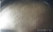 臉上長粉刺了能用祛痘精華嗎？有效果嗎？