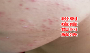 臉上長粉刺去粉刺的方法!不可錯過的去痘痘粉刺變美機會！