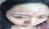臉上長粉刺怎樣去掉？醫院都沒搞定韓惜露幫我搞定了，超級開心！【視頻】
